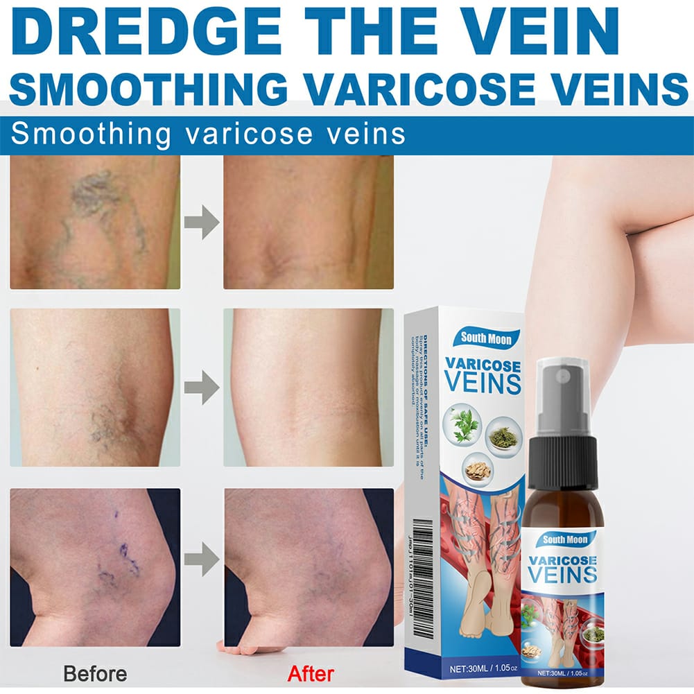 South Moon Varicose Veins Treatment Spray